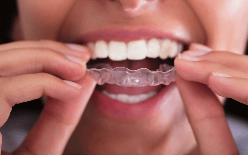 invisalign verzekering